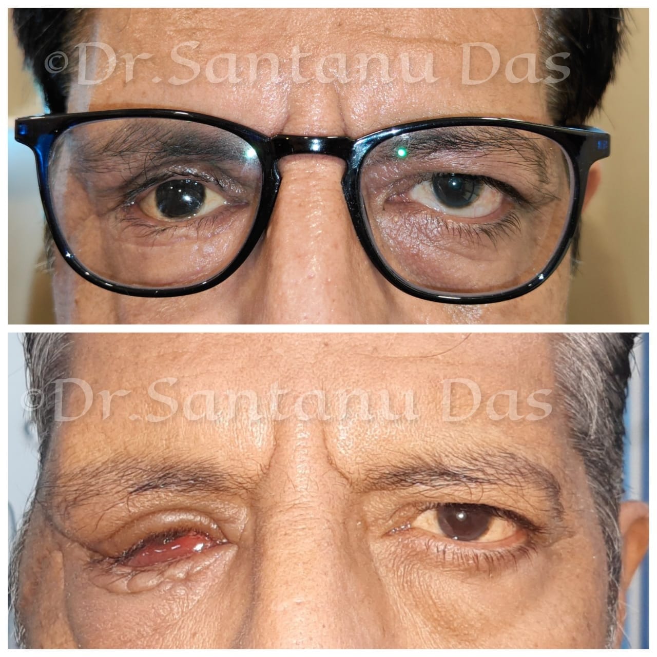 Enucleation Image